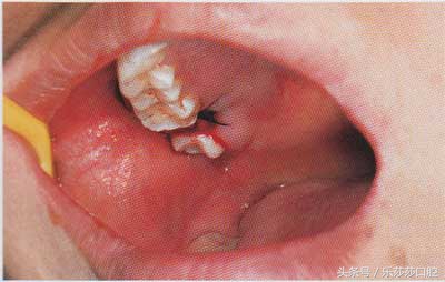 小孩可以下午拔牙吗,为什么下午不能拔牙迷信的说法