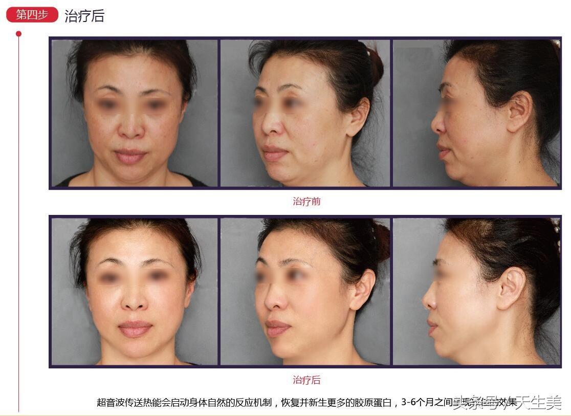 超声刀值得做吗 (超声刀怎么样啊)