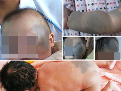 青胎记分哪几类,青胎记容易癌变吗