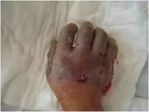 冬天生冻疮怎么办简单方法,冬天长冻疮是因为太冷了吗