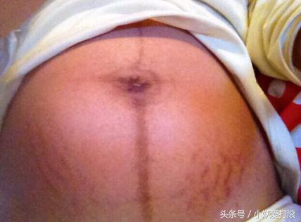 屁股也长妊娠纹,孕中期长妊娠纹用什么祛妊娠纹