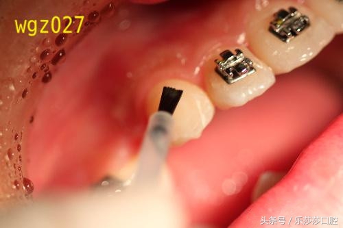 到底适不适合整牙,整牙到底有多可怕