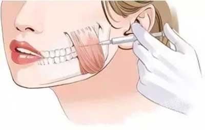 瘦脸针多少钱打一针,你一年要在脸上花多少钱