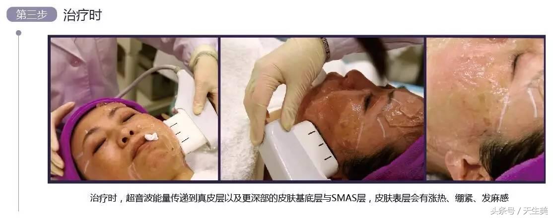 超声刀值得做吗 (超声刀怎么样啊)