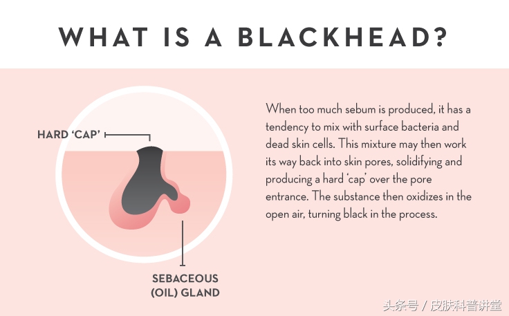 皮肤科医生毛孔粗大有黑头,黑头毛孔粗大看皮肤科有用吗