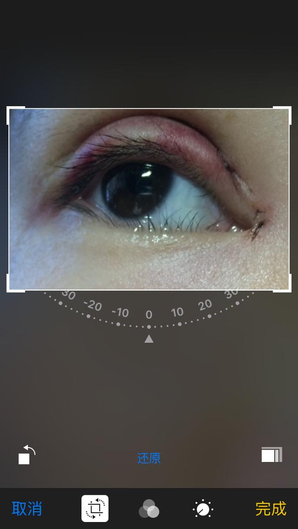 抽脂双眼皮做完眼睛有褶,割双眼皮肿成一条缝