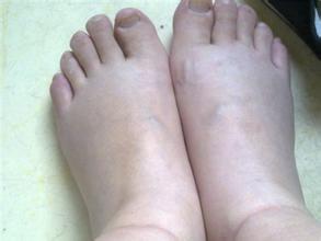 孕妇脚肿是怎么处理,孕妇脚肿是怎么回事中医解答