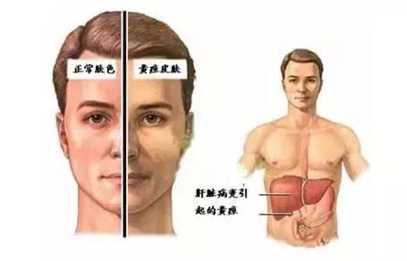 脸上长黄斑怎么检查,看脸上的斑如何知道什么病因