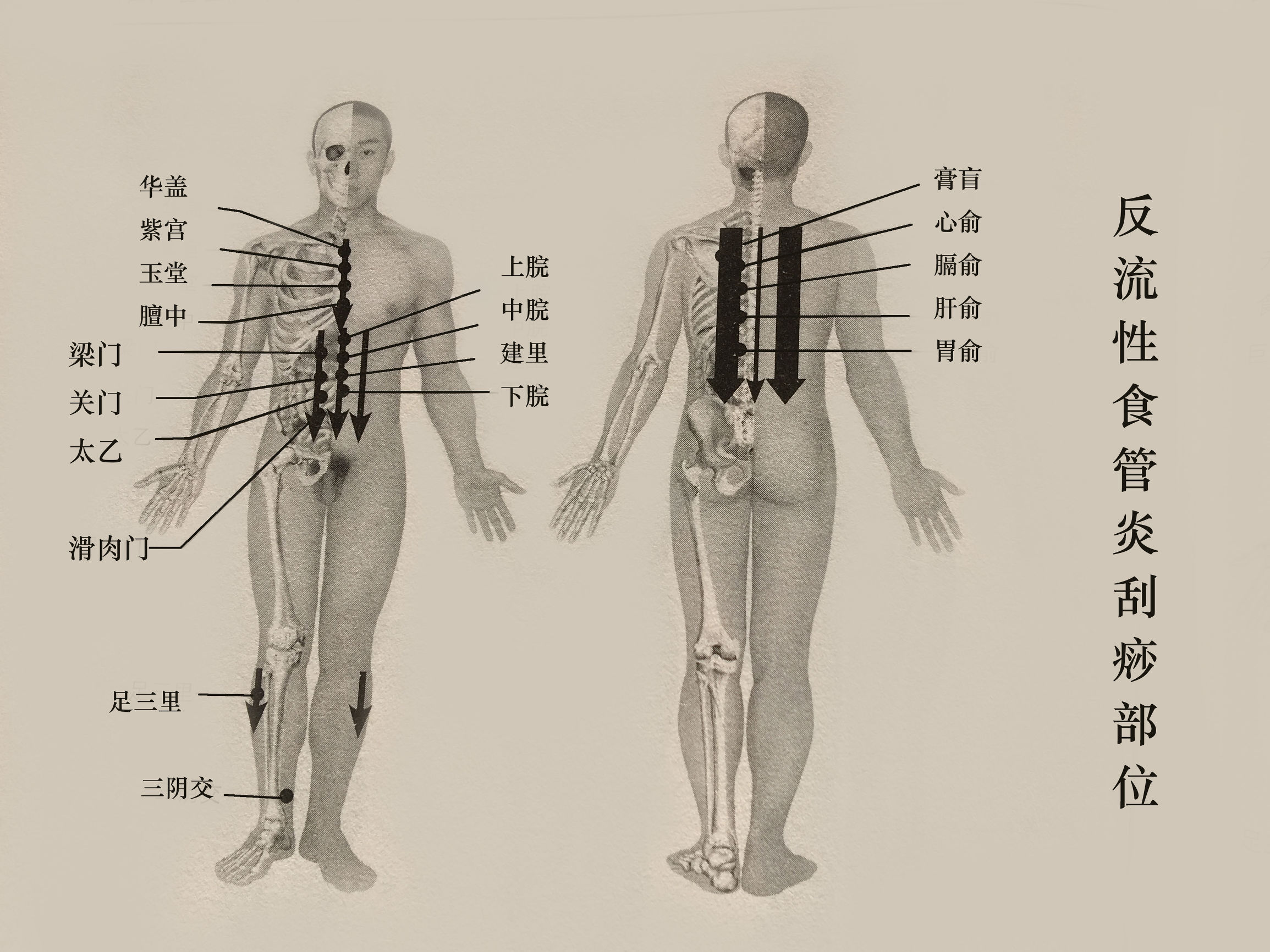 胃肠神经*能官**症、反流性食管炎的刮痧疗法