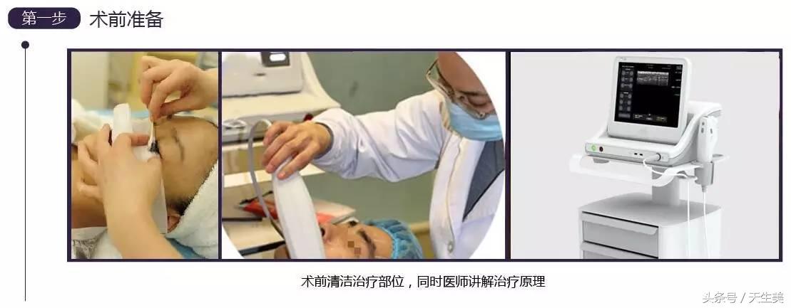 超声刀怎么样啊 (超声刀分享)