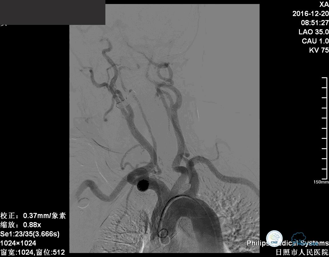 颈动脉瘤介入栓塞康复后可活多久,动脉瘤微创栓塞术全过程