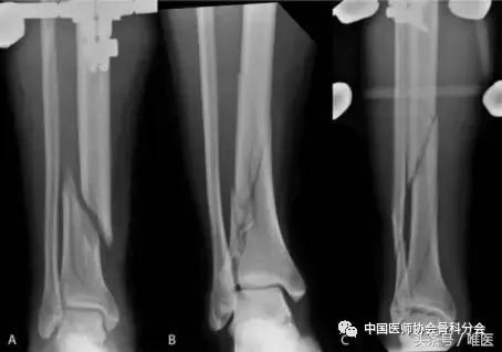 胫骨骨折髓内钉固定怎么锻炼,胫骨骨折髓内钉固定牢固吗