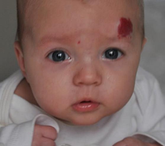 胎记如何治疗才可以不长,胎记能随着年龄的增长而消失吗