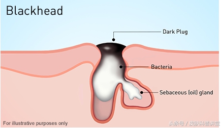 皮肤科医生毛孔粗大有黑头,黑头毛孔粗大看皮肤科有用吗
