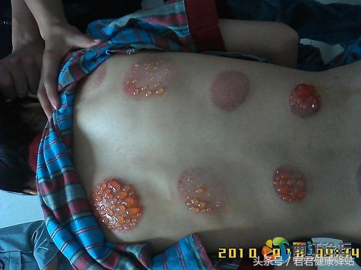 拔火罐印记是灰白颜色为什么,拔火罐的印子颜色代表了什么