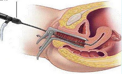 五个月前做了人流现在怀孕了,五六年做过人流还能怀孕吗