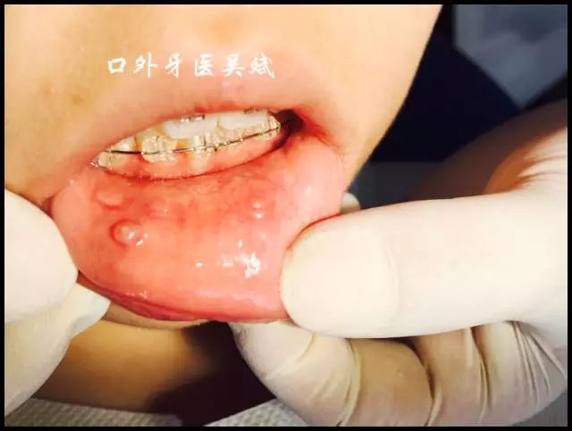 嘴里长疱疹怎么办,嘴里起脓疱怎么办