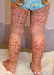 腿脚起红点是过敏性紫癜吗,小腿上出现小红点过敏性紫癜