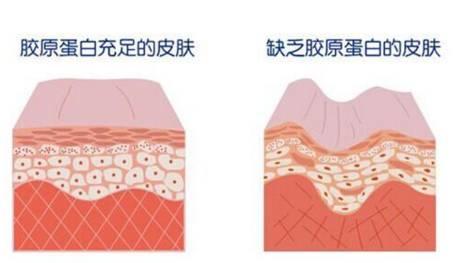 超声刀后必须吃修复型胶原蛋白吗,做完超声炮怎么补充胶原蛋白