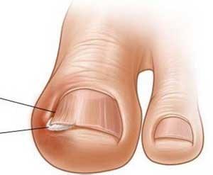 甲沟炎塞棉花法管用吗,甲沟炎塞棉花视频教程