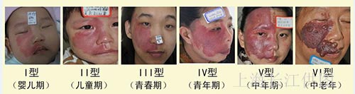 昔日胎记女,今日嫁给相同胎记的救命恩人