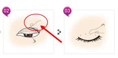 纳米无痕双眼皮埋线怎么恢复得快,埋线双眼皮拆线能恢复到原来吗