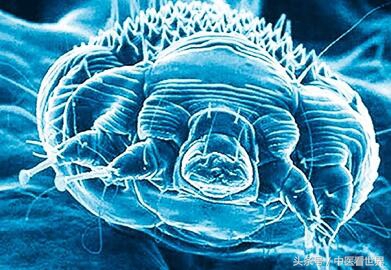 湿疹会传染吗要怎么治,湿疹会反复发作不会传染