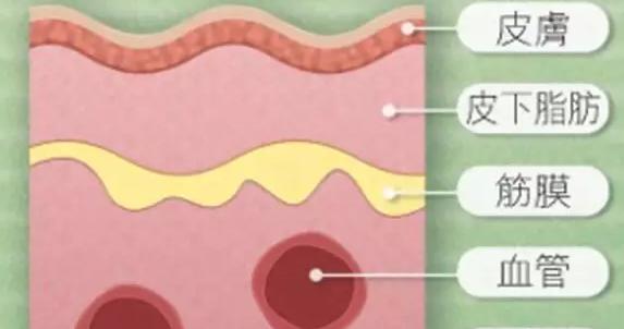 女白领熬夜突发腹痛患国际公认十大恐怖怪病之一——坏死性筋膜炎