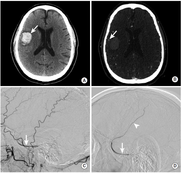 多图颅内出血影像学表现大全,头被撞后颅内出血有什么表现