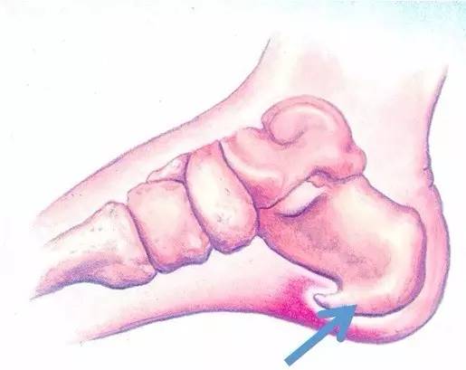 足跟骨刺的症状,足跟骨刺中药方