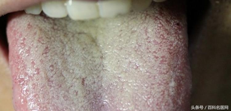 湿气困扰教你一招祛湿不再无效,湿气的三大克星