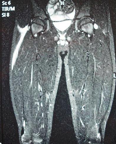 女白领熬夜突发腹痛患国际公认十大恐怖怪病之一——坏死性筋膜炎
