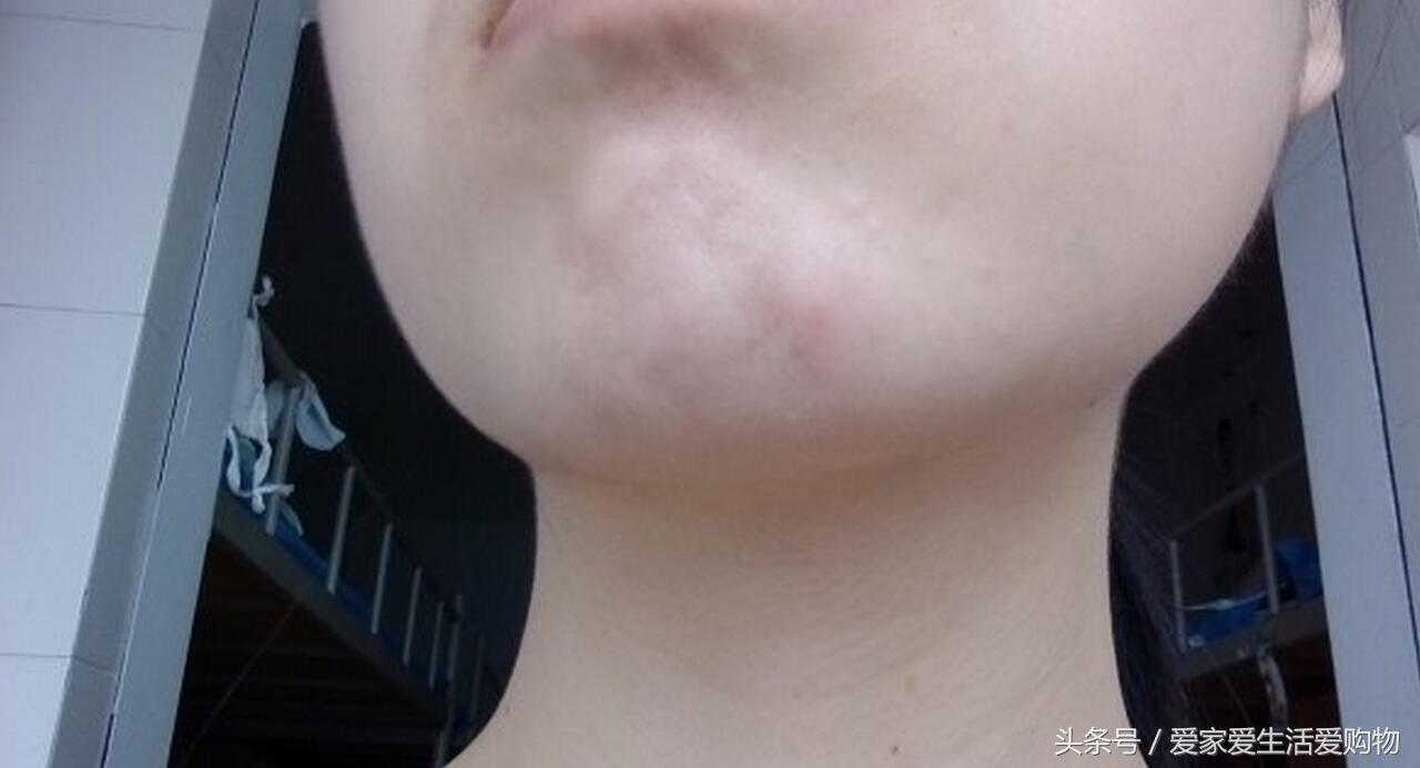 下巴长粉刺的正确消除方法,下巴长了一个粉刺下巴都肿了