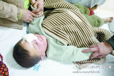 烟花掉下来砸到头,烟花男子右眼被炸伤