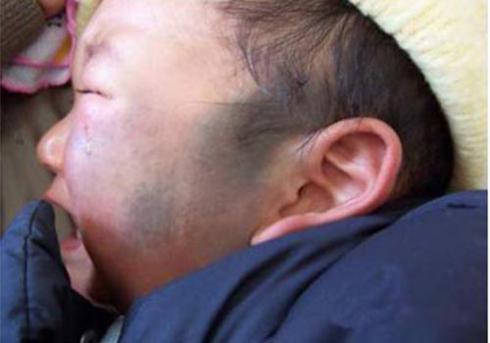 胎记去除特效药,胎记偏方