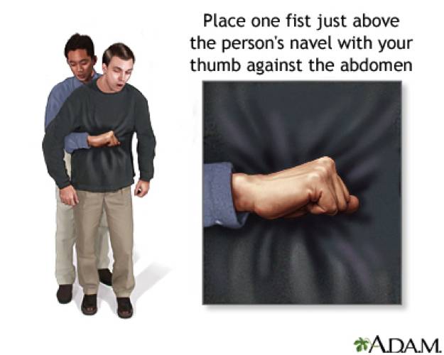 喉咙食物堵住了怎么办,食物卡住喉咙的急救方法