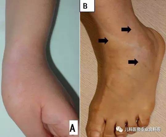 湿疹后有白斑是怎么回事,湿疹后白斑是白癜风