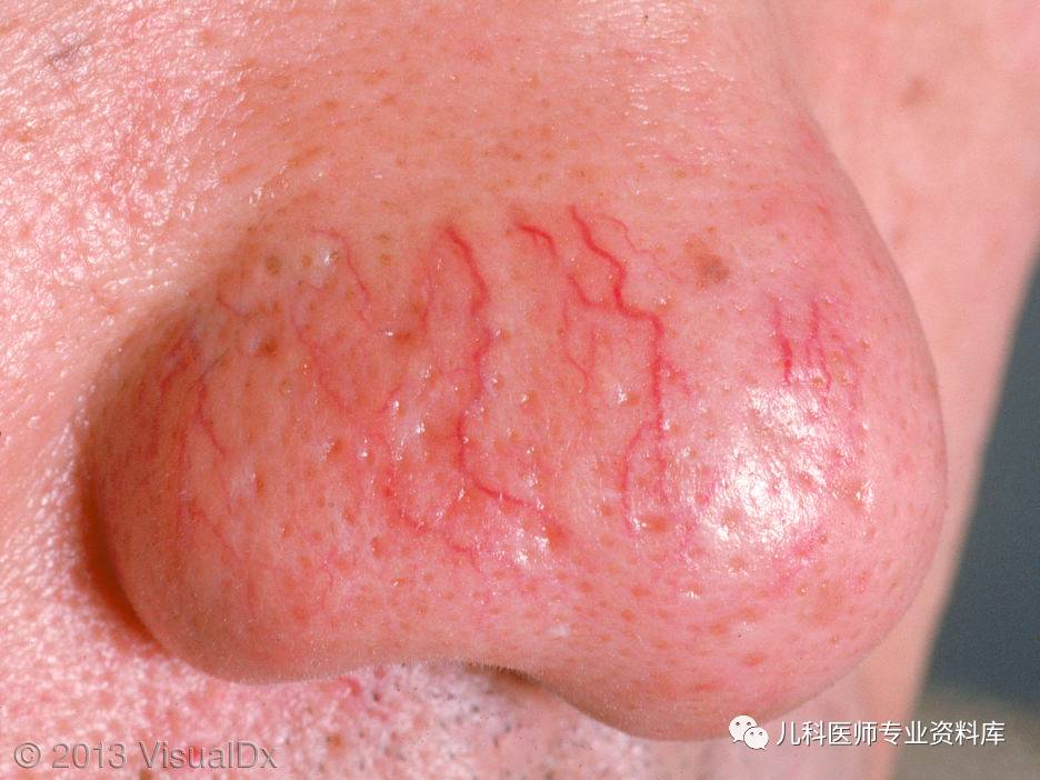 湿疹后有白斑是怎么回事,湿疹后白斑是白癜风