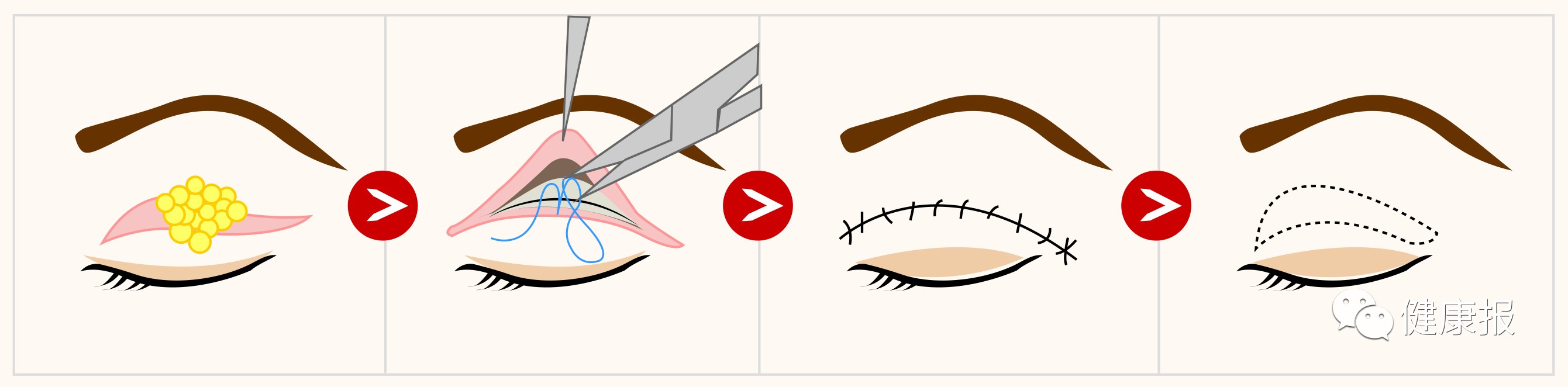 想割一个双眼皮怎么提前看到效果,想割双眼皮就割