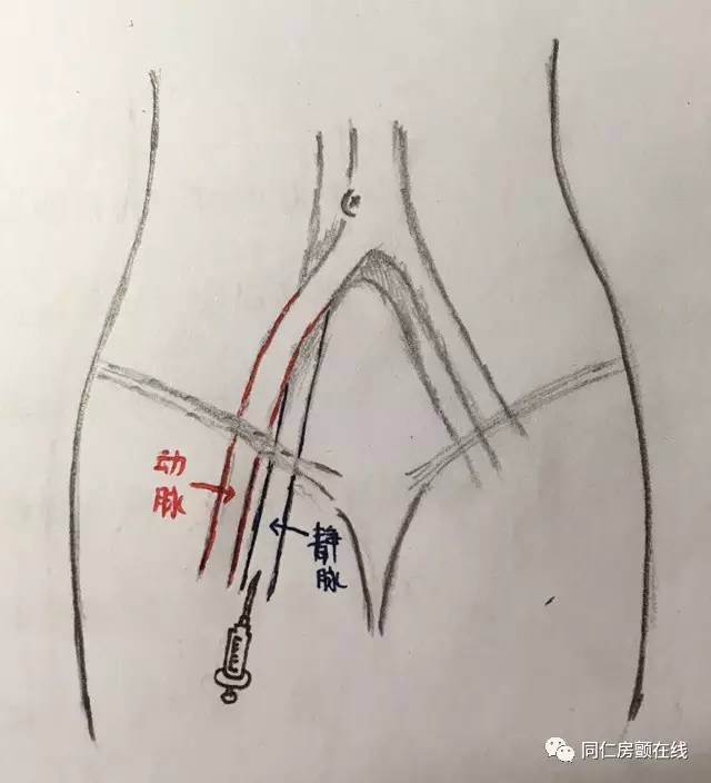 房颤射频消融术风险高吗,房颤导管射频消融手术的利弊