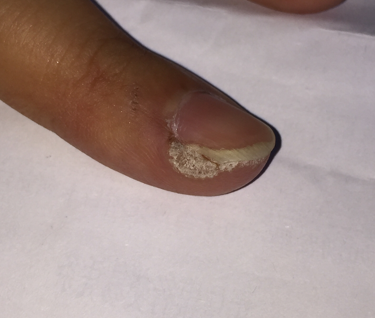 我是艾滋病的五弟，长在隐私部位，形态像菜花，比较难治愈！