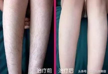 冰点无痛面部脱毛怎么做,冰点无痛永久脱毛教程