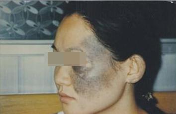 手肘蓝色的痣是胎记,胎记痣的颜色变浅像长到肉里了