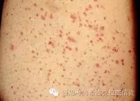 血小板减少吃什么食物,免疫性血小板减少治疗