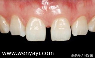 门牙有缝是什么说法,门牙有缝怎么办如何补救
