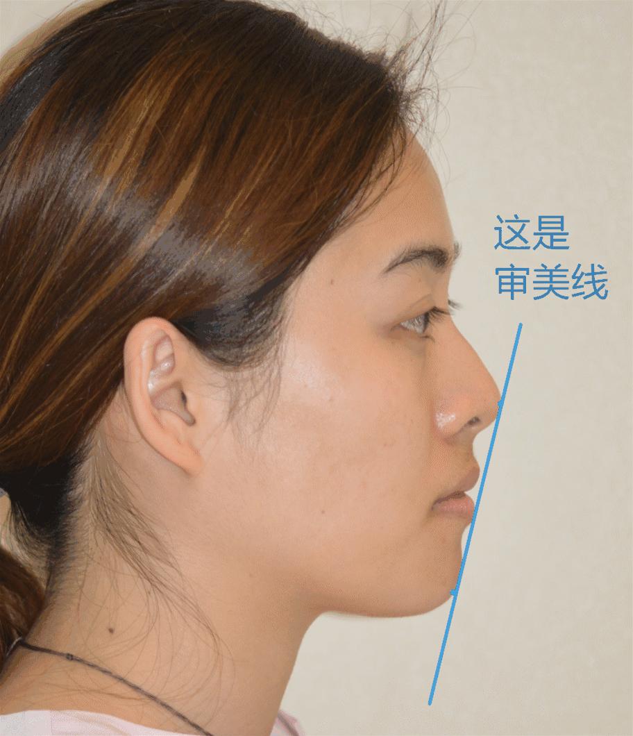 矫正前一定要做口扫吗,矫正前必须拍ct吗