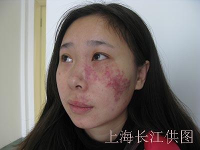 胎记不及时治疗会恶变吗,胎记不治疗对生命有影响吗