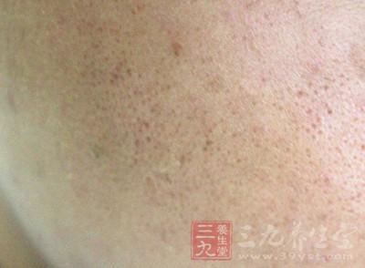 去粉刺的治愈过程放大,粉刺针去除粉刺后有黑印