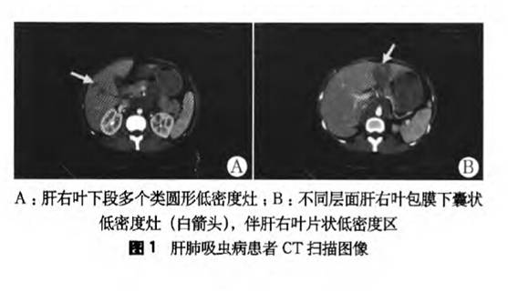 病检嗜酸性粒细胞增多提示啥病,嗜酸性粒细胞升高并且腹痛