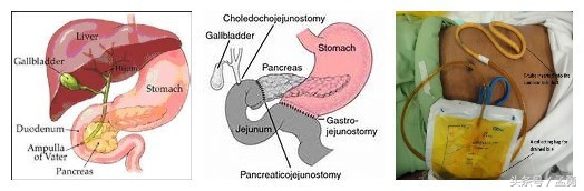 轻微的胆管系统损伤,胆管阻塞治疗方法